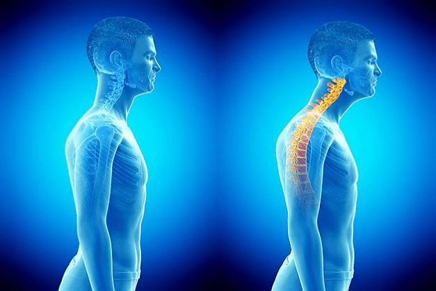 Do chiropractors recommend posture correctors